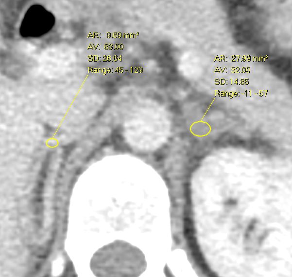 File:Acute unilateral nonhemorrhagic adrenal infarction (Radiopaedia 67560-76961 Axial nephrographic 1).jpg