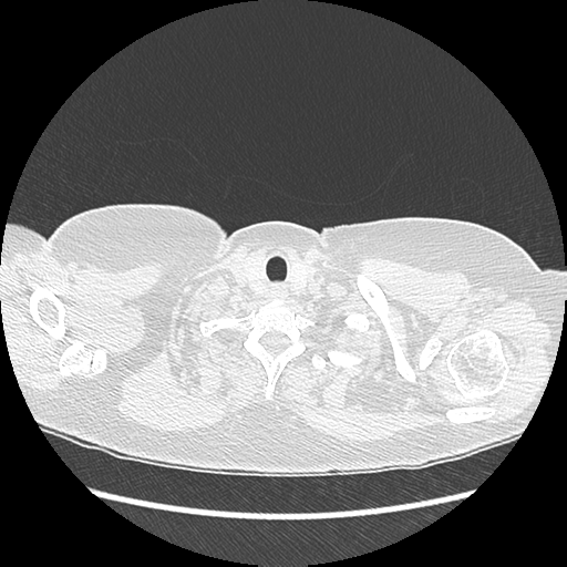 Adenocarcinoma in situ of lung (Radiopaedia 38685-40829 B 10).png