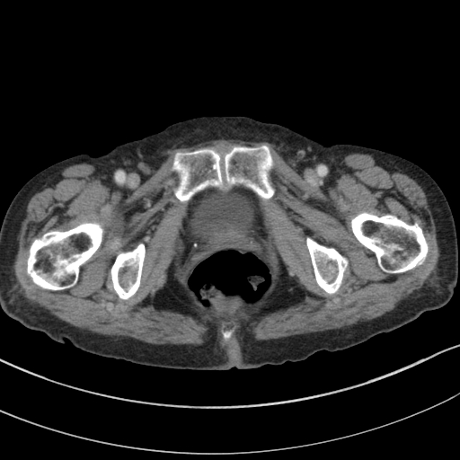 Adenocarcinoma of cecum (Radiopaedia 59222-66549 Axial C+ portal venous phase 159).jpg