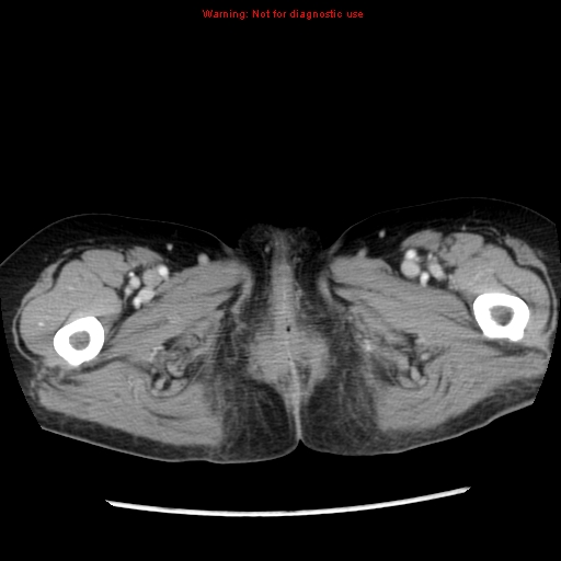 File:Adenocarcinoma of the colon (Radiopaedia 8191-9039 Axial liver window 83).jpg