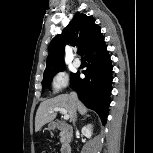 Adenocarcinoma of the lung (Radiopaedia 59871-67325 Sagittal C+ arterial phase 39).jpg