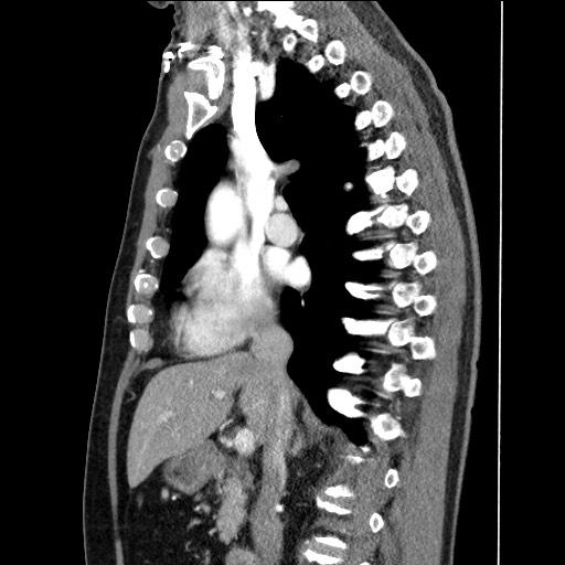 File:Adenocarcinoma of the lung (Radiopaedia 59871-67325 Sagittal C+ arterial phase 43).jpg