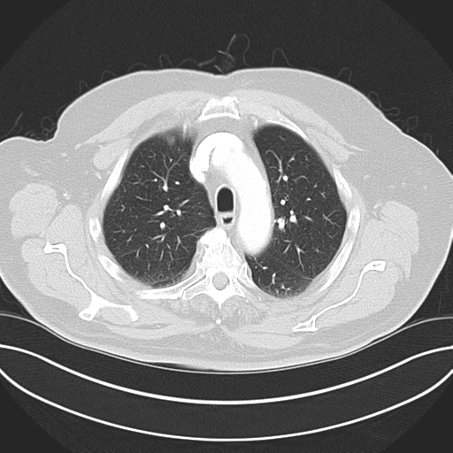 Adenocarcioma of rectum- T1 lesion (Radiopaedia 36921-38547 Axial lung window 18).png