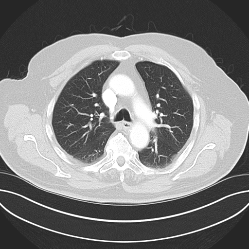Adenocarcioma of rectum- T1 lesion (Radiopaedia 36921-38547 Axial lung window 22).png