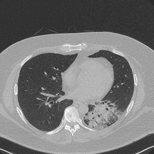 Adenoid cystic carcinoma of the trachea (Radiopaedia 49042-54137 Axial lung window 208).jpg