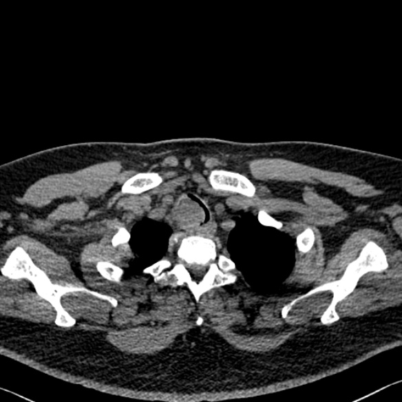 File:Adenoid cystic carcinoma of the trachea (Radiopaedia 49042-54137 Axial non-contrast 31).jpg