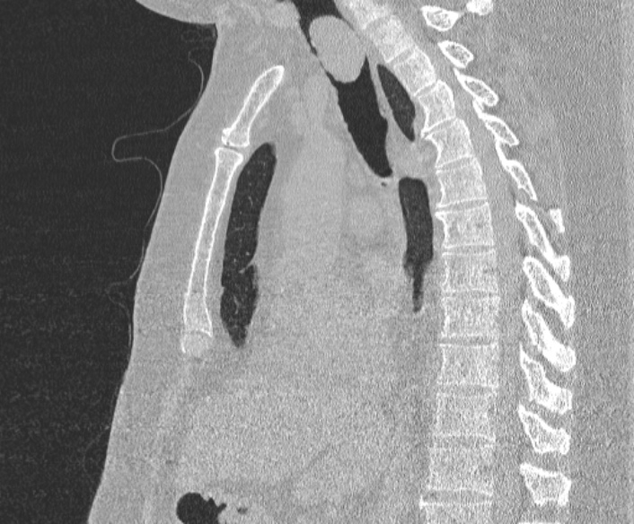 Adenoid cystic carcinoma of the trachea (Radiopaedia 49042-54137 Sagittal lung window 231).jpg
