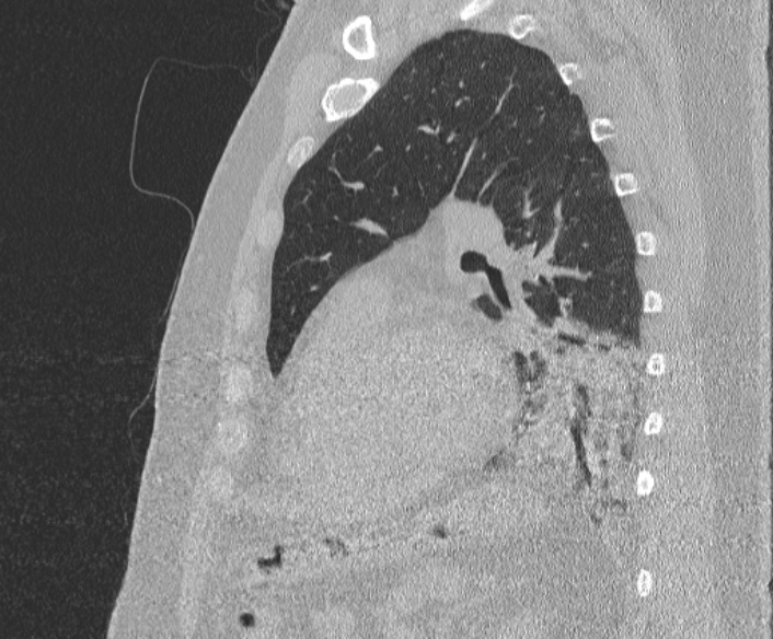Adenoid cystic carcinoma of the trachea (Radiopaedia 49042-54137 Sagittal lung window 305).jpg