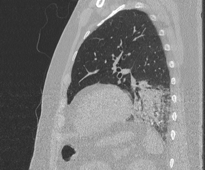 Adenoid cystic carcinoma of the trachea (Radiopaedia 49042-54137 Sagittal lung window 333).jpg