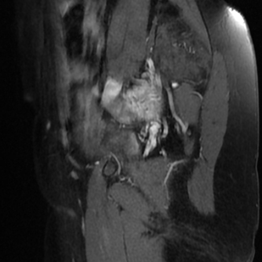 File:Adenoma malignum of cervix (Radiopaedia 66441-75705 Sagittal T1 C+ fat sat 1).jpg
