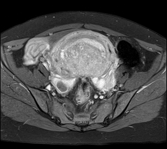 File:Adenomyosis - ovarian endometriomas (Radiopaedia 67031-76350 Axial T1 C+ fat sat 11).jpg