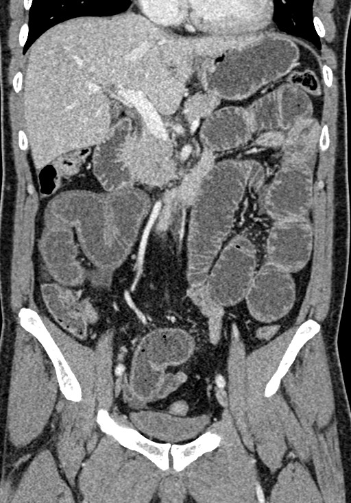Adhesional small bowel obstruction (Radiopaedia 58900-66131 Coronal C+ portal venous phase 130).jpg