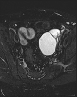 File:Adnexal multilocular cyst (O-RADS US 3- O-RADS MRI 3) (Radiopaedia 87426-103754 Axial T2 fat sat 11).jpg