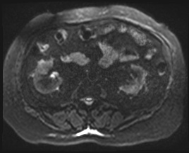 Adrenal cortical carcinoma (Radiopaedia 64017-72770 Axial DWI 69).jpg
