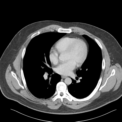 File:Adrenal cyst (Radiopaedia 45625-49777 Axial C+ portal venous phase 3).png