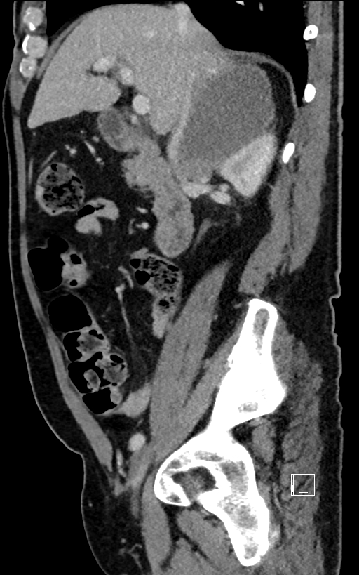 Adrenal lymphoma (Radiopaedia 73730-84529 Sagittal C+ portal venous phase 41).jpg