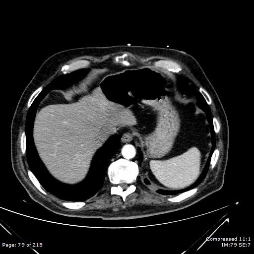 Adrenal metastasis (Radiopaedia 78425-91079 Axial C+ arterial phase 9).jpg
