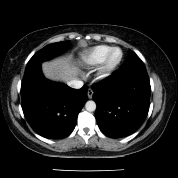 Adrenal myelolipoma (Radiopaedia 43401-46759 Axial C+ portal venous phase 5).jpg