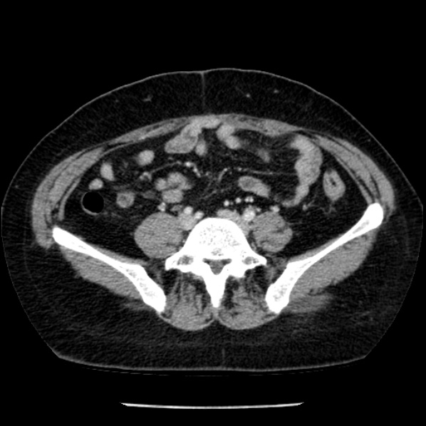 Adrenal myelolipoma (Radiopaedia 43401-46759 Axial C+ portal venous phase 59).jpg