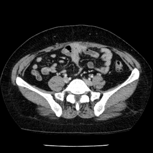 Adrenal myelolipoma (Radiopaedia 43401-46759 Axial C+ portal venous phase 61).jpg