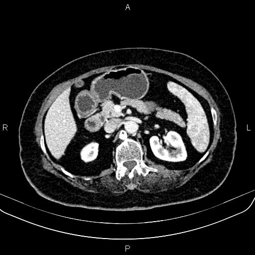 Adrenal myelolipoma (Radiopaedia 82742-96986 Axial renal cortical phase 64).jpg