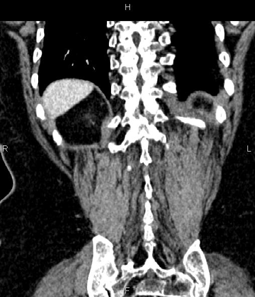Adrenal myelolipoma (Radiopaedia 82742-96986 Coronal renal cortical phase 64).jpg