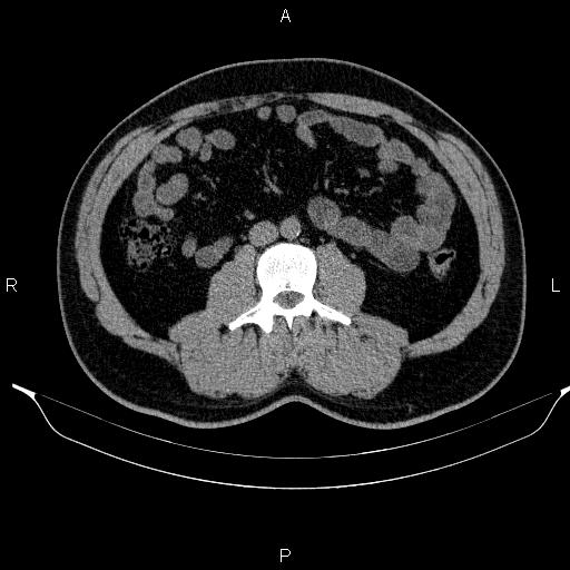 Adrenal myelolipoma (Radiopaedia 84321-99619 Axial non-contrast 61).jpg