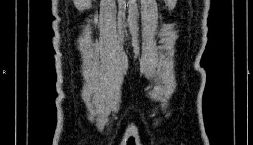 Adrenal myelolipoma (Radiopaedia 84321-99619 Coronal non-contrast 79).jpg