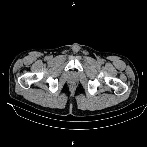 Adrenal myelolipoma (Radiopaedia 87794-104246 Axial non-contrast 110).jpg