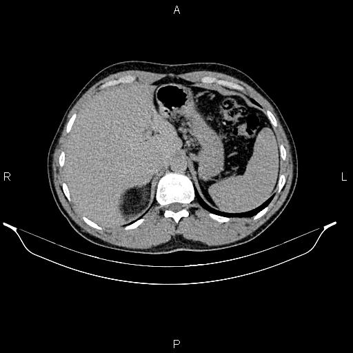 Adrenal myelolipoma (Radiopaedia 87794-104246 Axial renal excretory phase 21).jpg