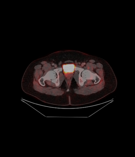 Adrenocortical carcinoma (Radiopaedia 80134-93440 ِAxial 252).jpg