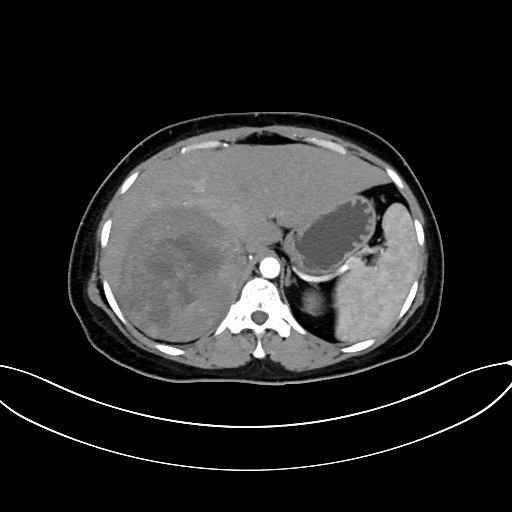 Adrenocortical carcinoma (Radiopaedia 87281-103569 Axial C+ arterial phase 23).jpg