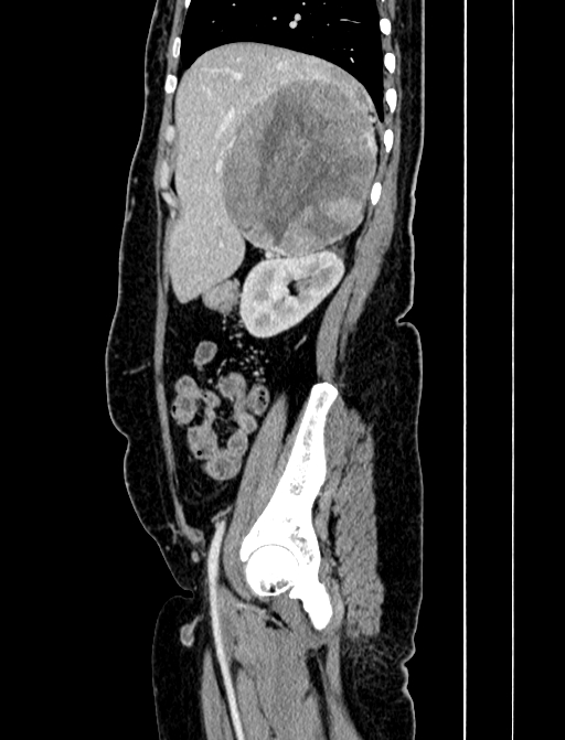 Adrenocortical carcinoma (Radiopaedia 87281-103569 Sagittal C+ portal venous phase 68).jpg