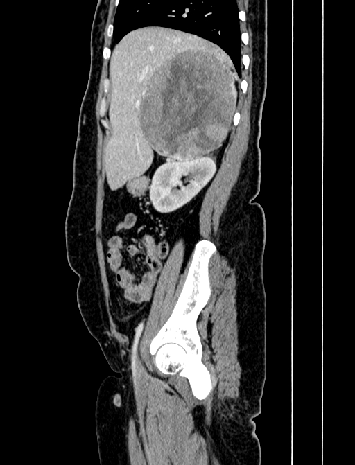 Adrenocortical carcinoma (Radiopaedia 87281-103569 Sagittal C+ portal venous phase 71).jpg