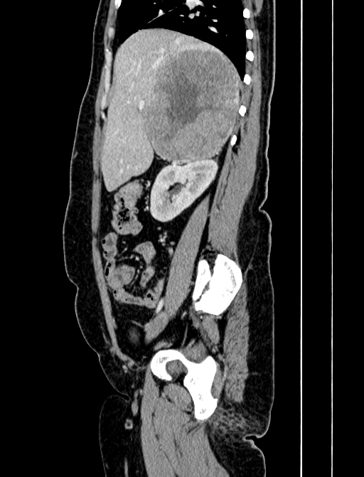 Adrenocortical carcinoma (Radiopaedia 87281-103569 Sagittal C+ portal venous phase 88).jpg