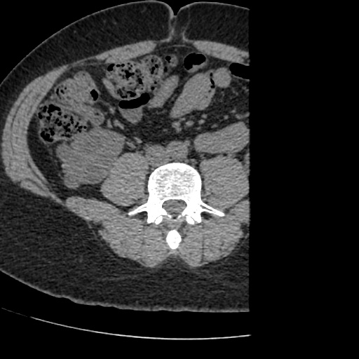 Adult polycystic kidney disease (Radiopaedia 59075-66368 Axial non-contrast 55).jpg