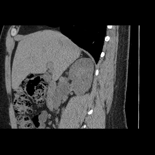Adult polycystic kidney disease (Radiopaedia 59075-66368 Sagittal non-contrast 27).jpg