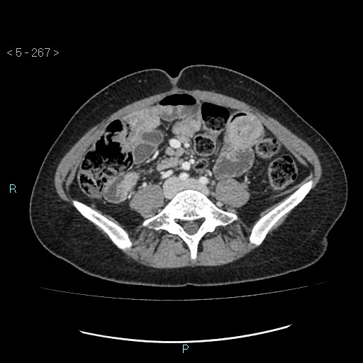 Adult transient intestinal intussusception (Radiopaedia 34853-36310 Axial C+ portal venous phase 59).jpg