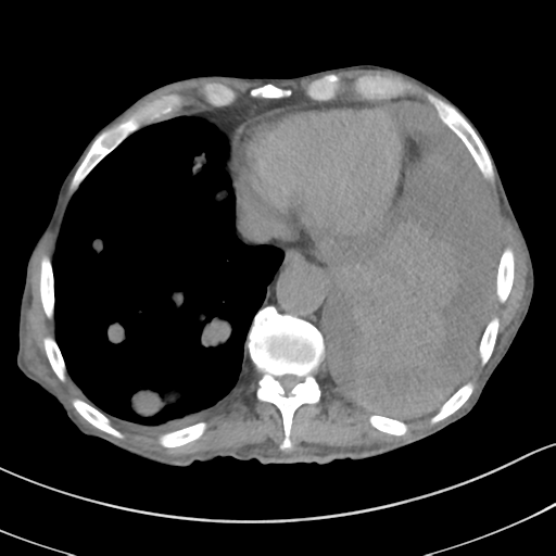 Advanced metastatic lung cancer (Radiopaedia 48910-53954 Axial non-contrast 47).png