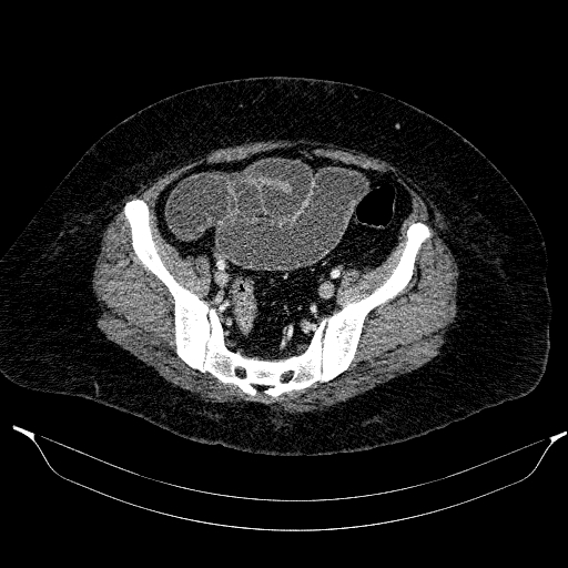Afferent loop syndrome - secondary to incarcerated trocar site hernia (Radiopaedia 82959-97305 Axial C+ portal venous phase 187).jpg