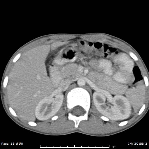 File:Agenesis of the gallbladder (Radiopaedia 55454-61905 B 33).jpg