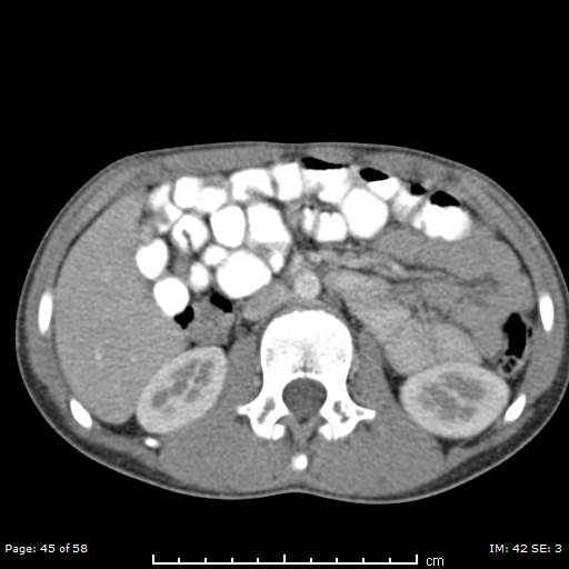 File:Agenesis of the gallbladder (Radiopaedia 55454-61905 B 45).jpg
