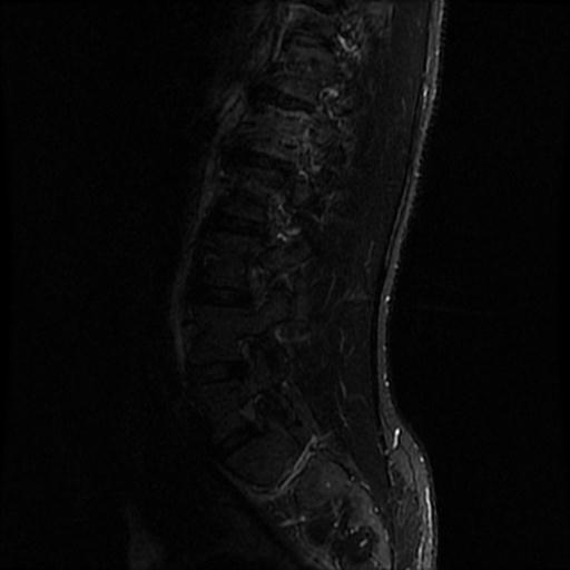 File:Aggressive vertebral hemangioma with pathological fracture (Radiopaedia 69528-79411 Sagittal STIR 9).jpg