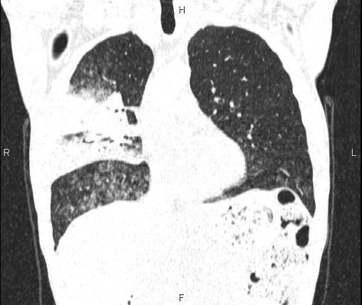 File:Air bronchogram in pneumonia (Radiopaedia 85719-101512 Coronal lung window 24).jpg