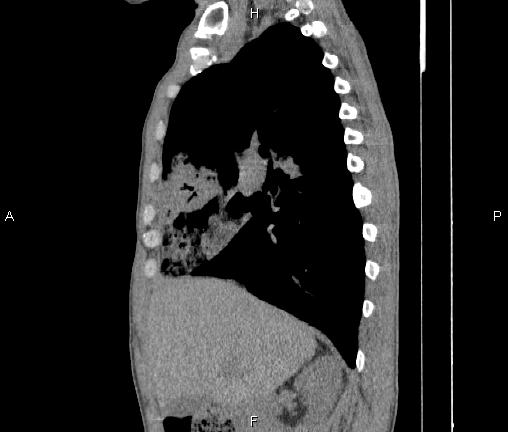 File:Air bronchogram in pneumonia (Radiopaedia 85719-101512 F 35).jpg