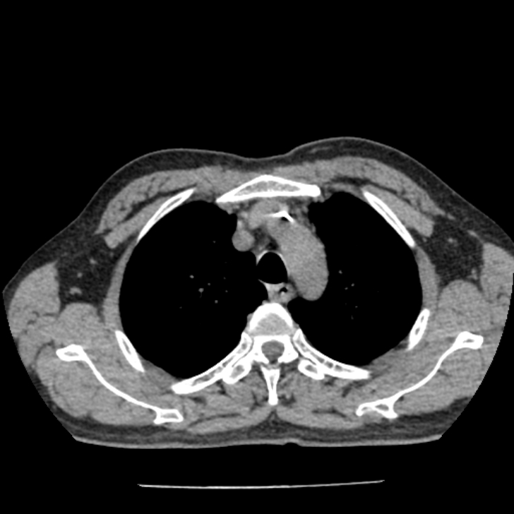 Airway foreign body in adult (Radiopaedia 85907-101779 Axial liver window 27).jpg