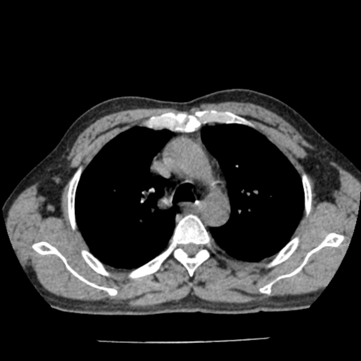 Airway foreign body in adult (Radiopaedia 85907-101779 Axial liver window 43).jpg