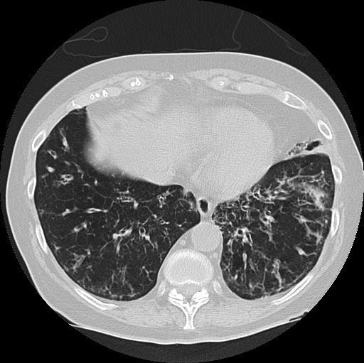 Alpha-1-antitrypsin deficiency (Radiopaedia 72058-82557 Axial lung window 55).jpg