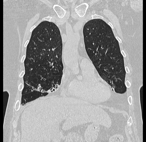 File:Alpha-1-antitrypsin deficiency (Radiopaedia 72058-82557 Coronal lung window 15).jpg