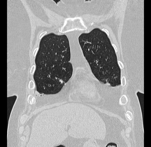 File:Alpha-1-antitrypsin deficiency (Radiopaedia 72058-82557 Coronal lung window 4).jpg